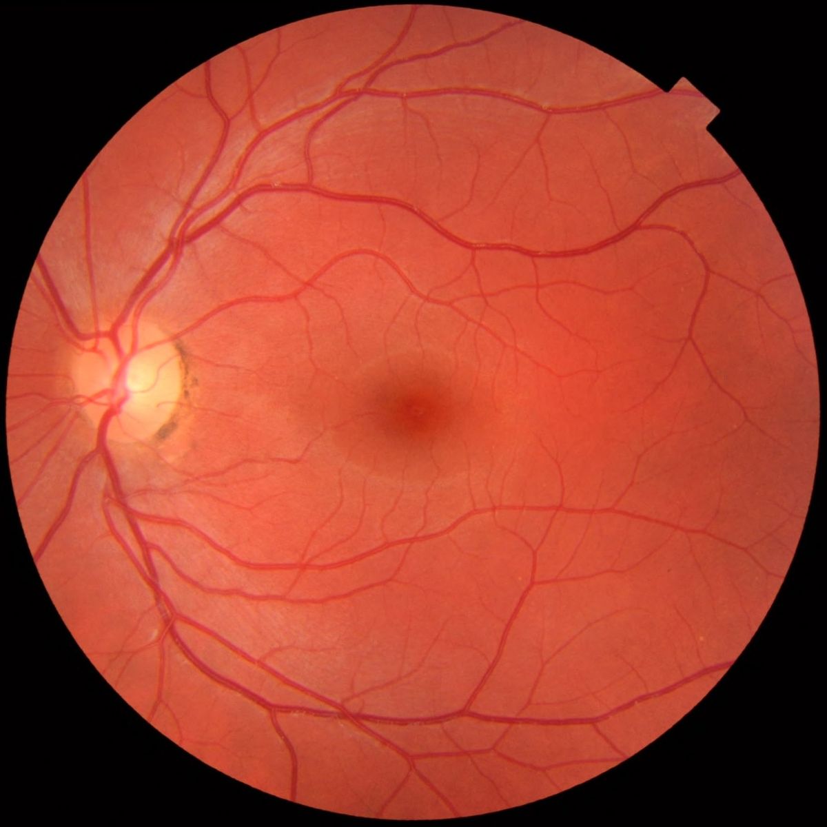 DR Detection